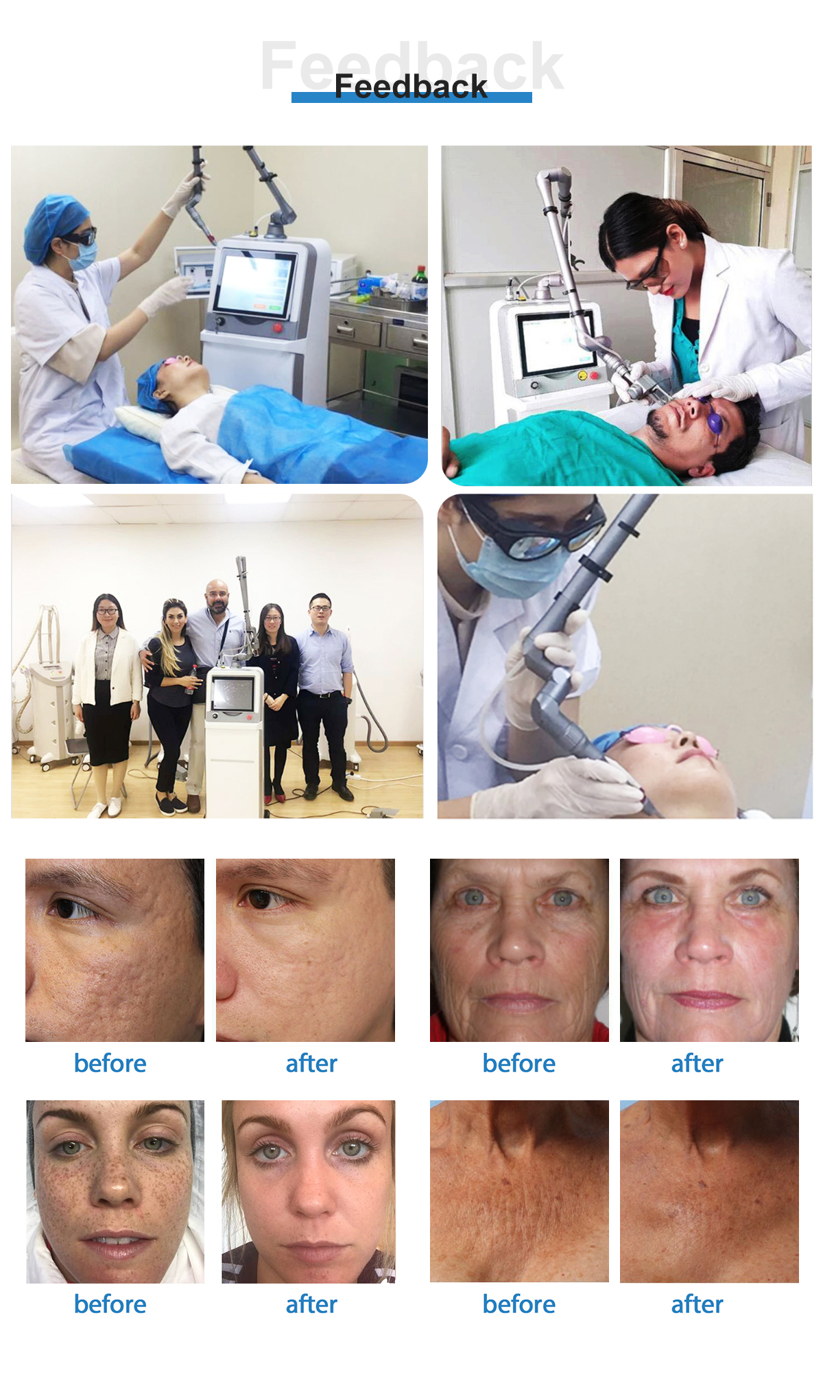 FDA approved Fractional CO2 Laser FDA approved Fractional CO2 Laser