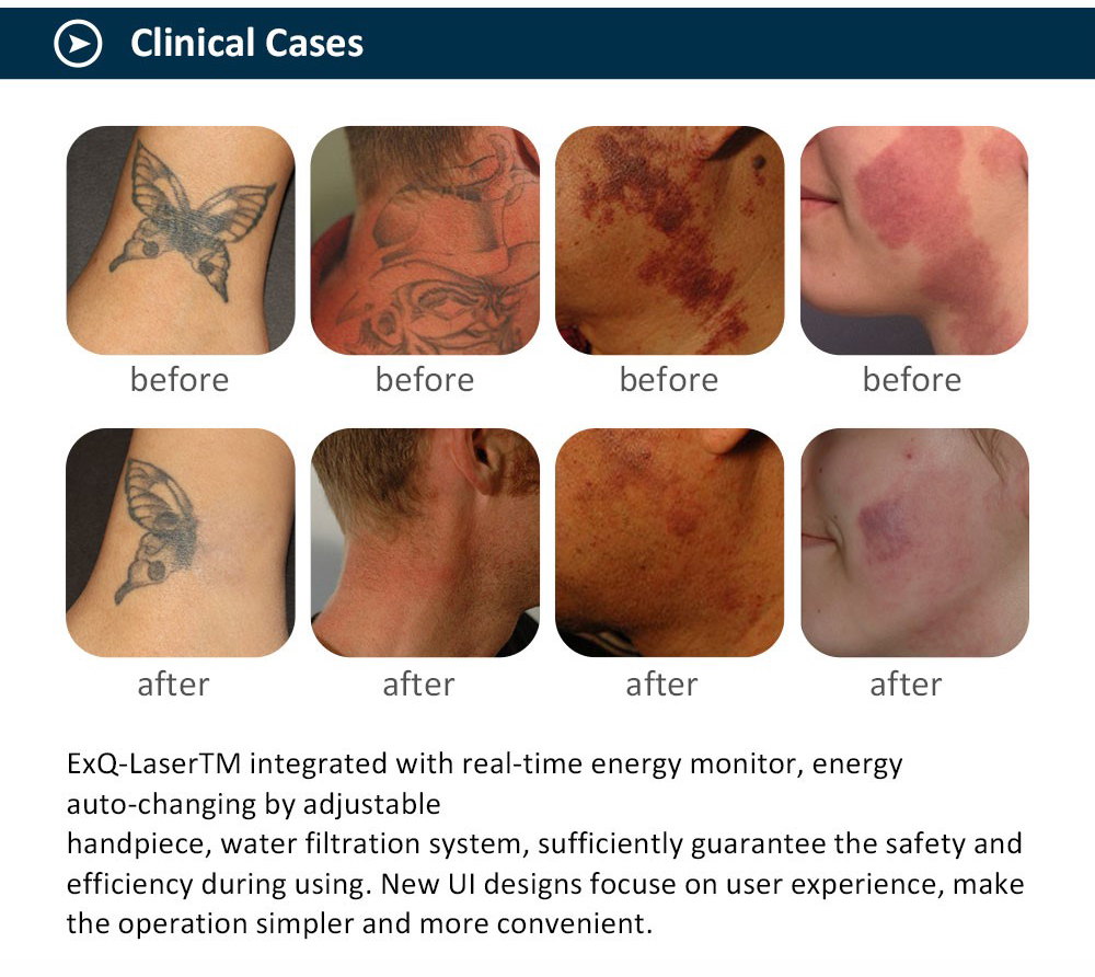 Q- switch ND: YAG laser therapy system