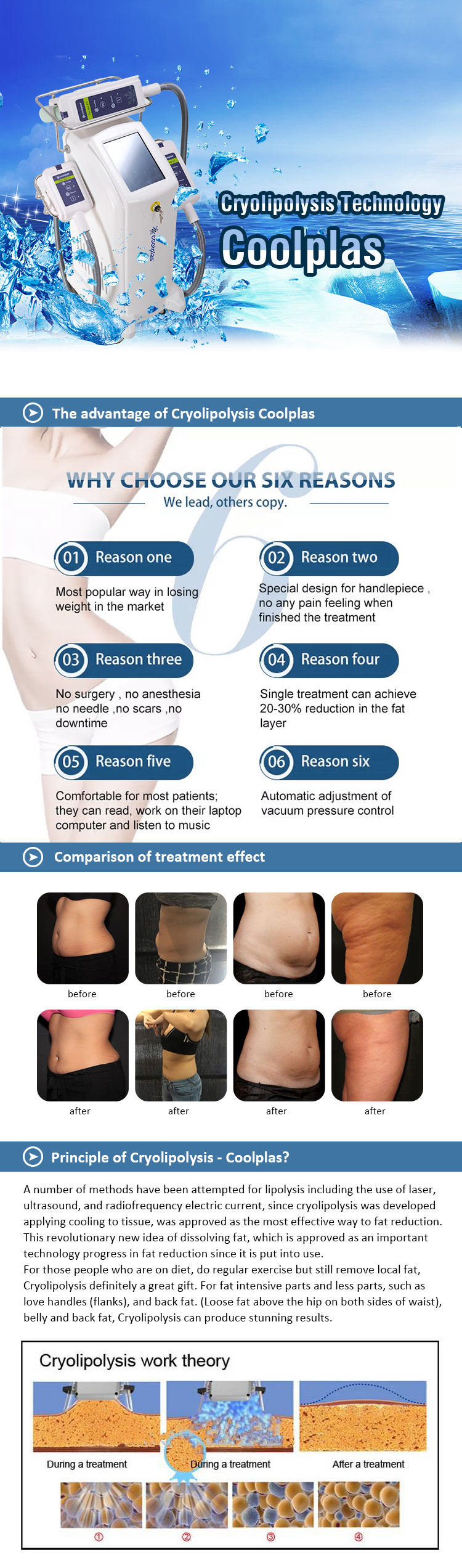 Cryolipolysis Technology - Coolplas