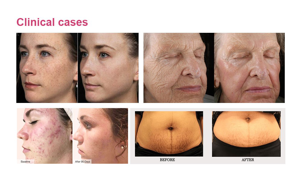 Tixel- new energy lattice skin repair system