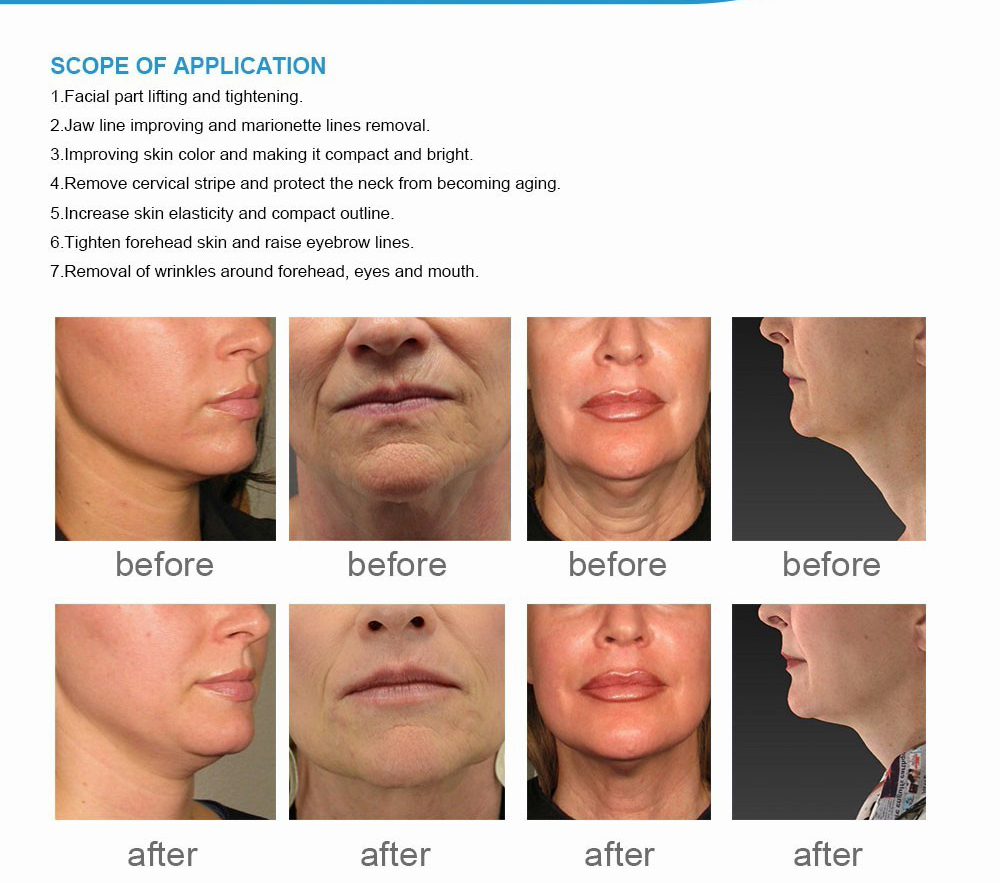 Radar HIFU facial lifting and wrinkle removal machine