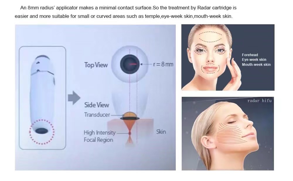 Radar HIFU facial lifting and wrinkle removal machine