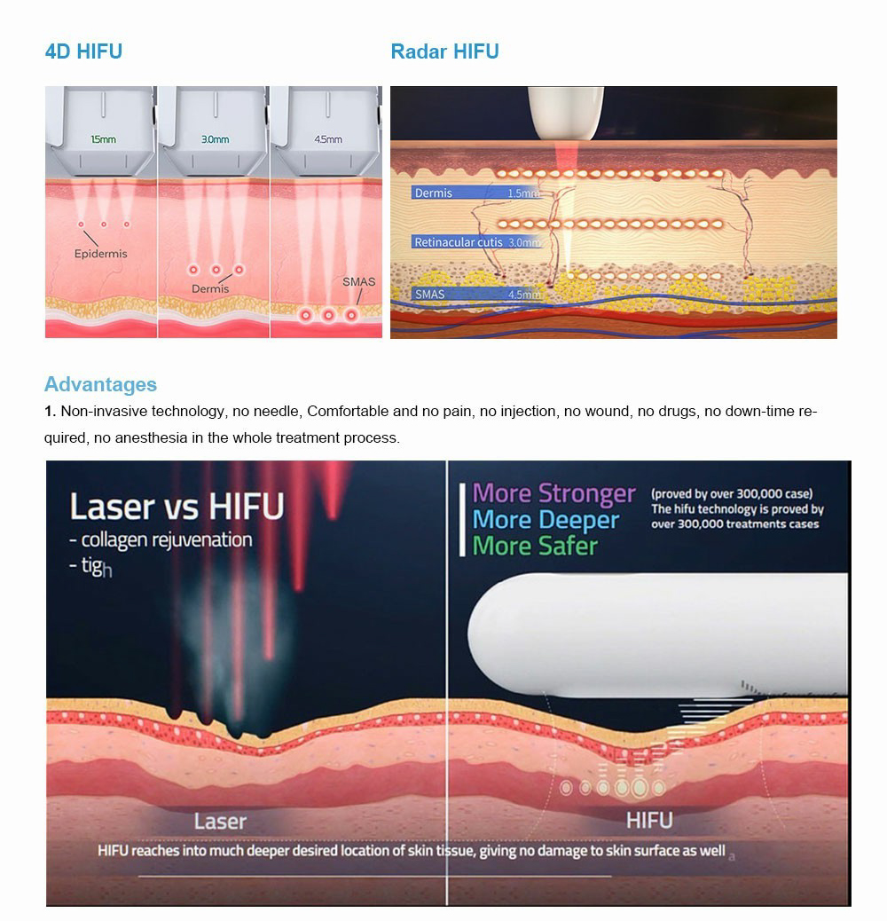 Radar HIFU facial lifting and wrinkle removal machine