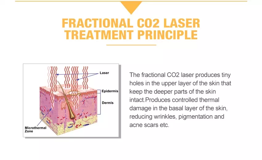 Portable Co2 laser machine Portable Co2 laser machine