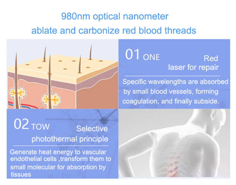 980 nm Spider Vein Removal Machine 980 nm Spider Vein Removal Machine