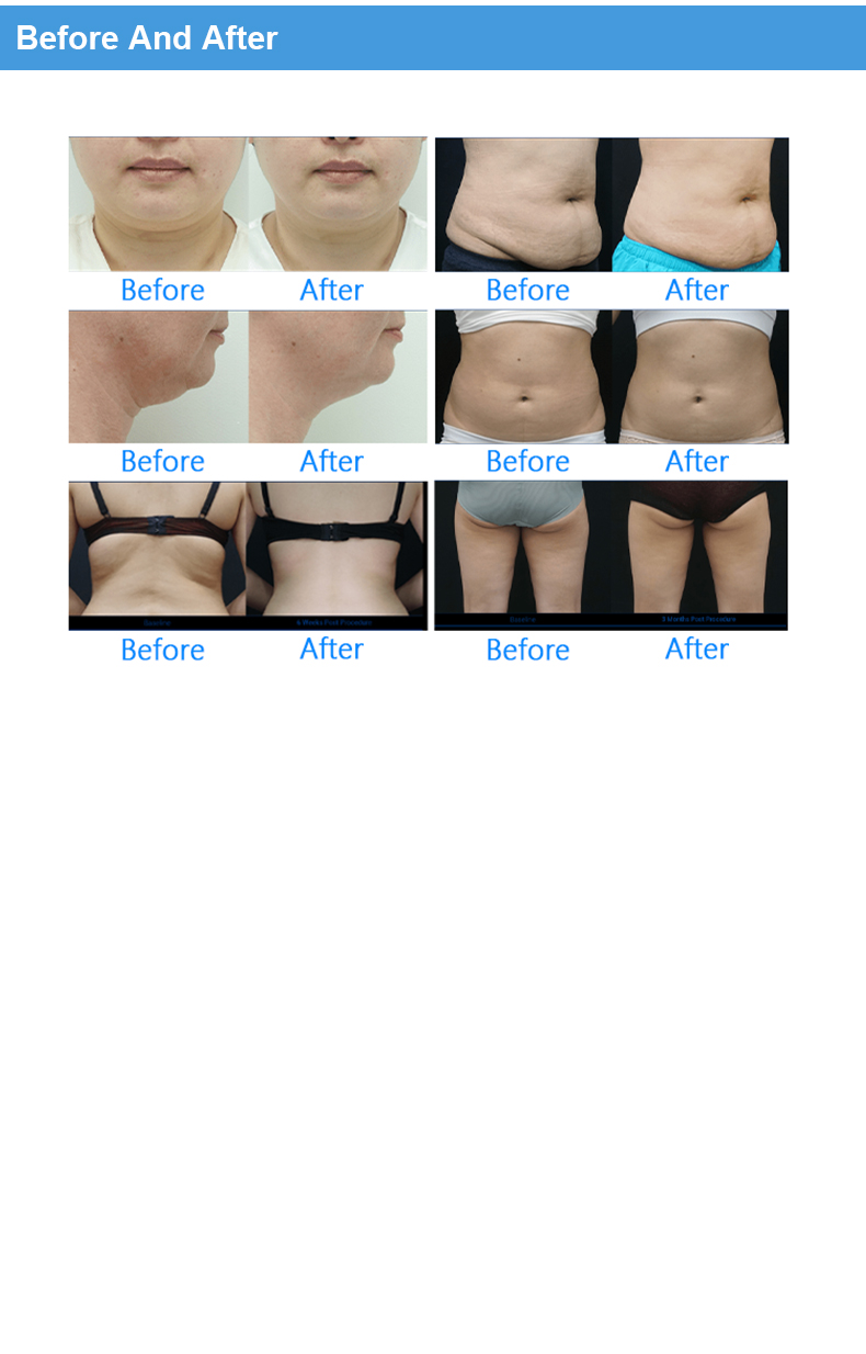 360° Cryolipolysis Fat Freezing machine