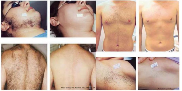 Diode Laser & Nd:Yag Laser 2 in 1 Machine Diode Laser & Nd:Yag Laser 2 in 1 Machine