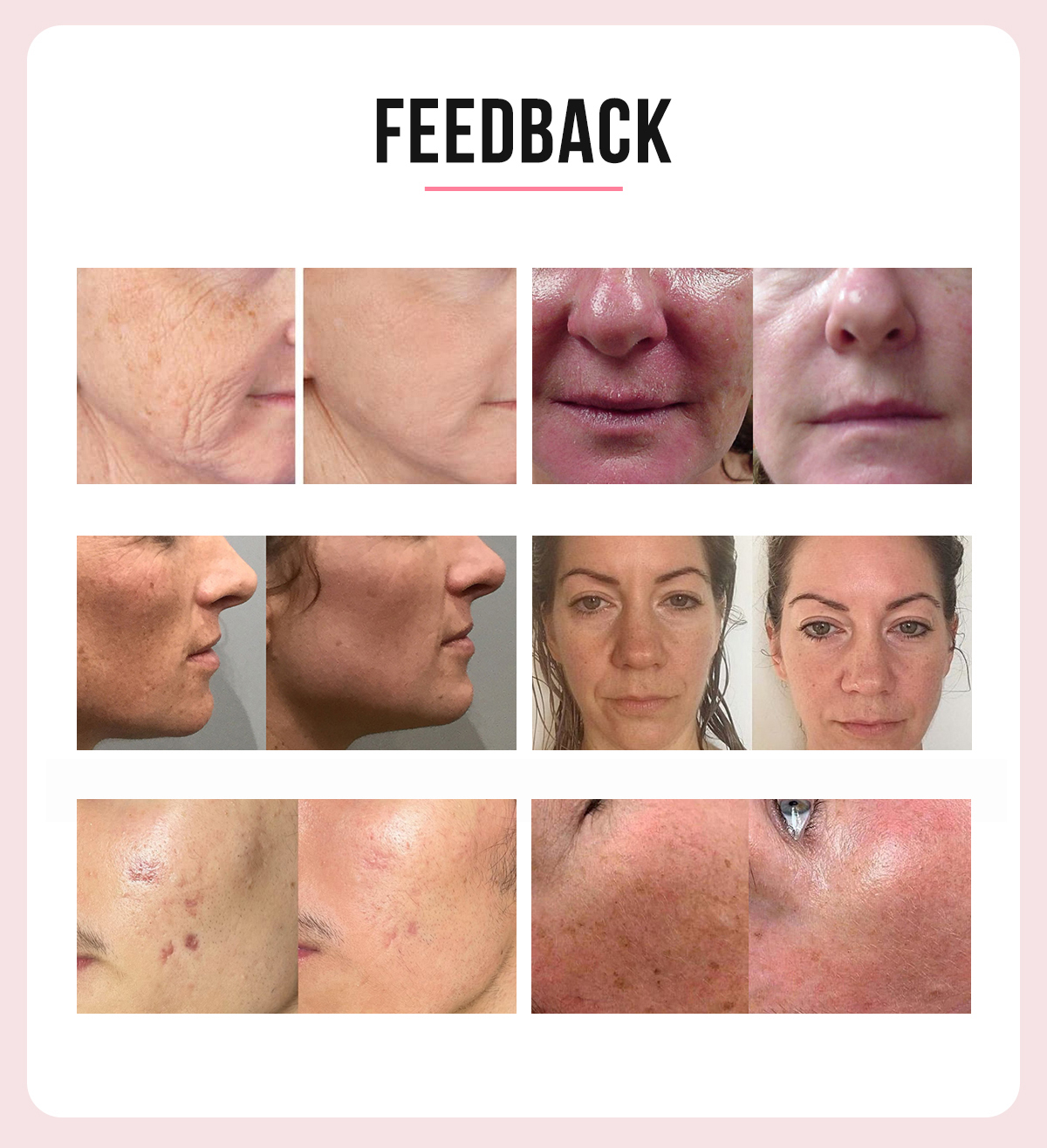 10D HIFU (4D HIFU+Vmax+Liposonix+Vaginal HIFU+Vaginal Test+Mirconeedling RF) 10D HIFU (4D HIFU+Vmax+Liposonix+Vaginal HIFU+Vaginal Test+Mirconeedling RF)