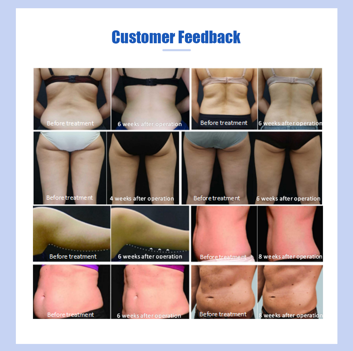 8 lce sculpture board cryolipolysis machine