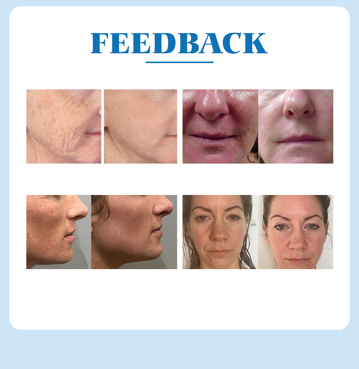 2 IN 1 HIFU Ultrasonic face and body shaping machine (4D HIFU + Radar HIFU) 2 IN 1 HIFU Ultrasonic face and body shaping machine (4D HIFU + Radar HIFU)