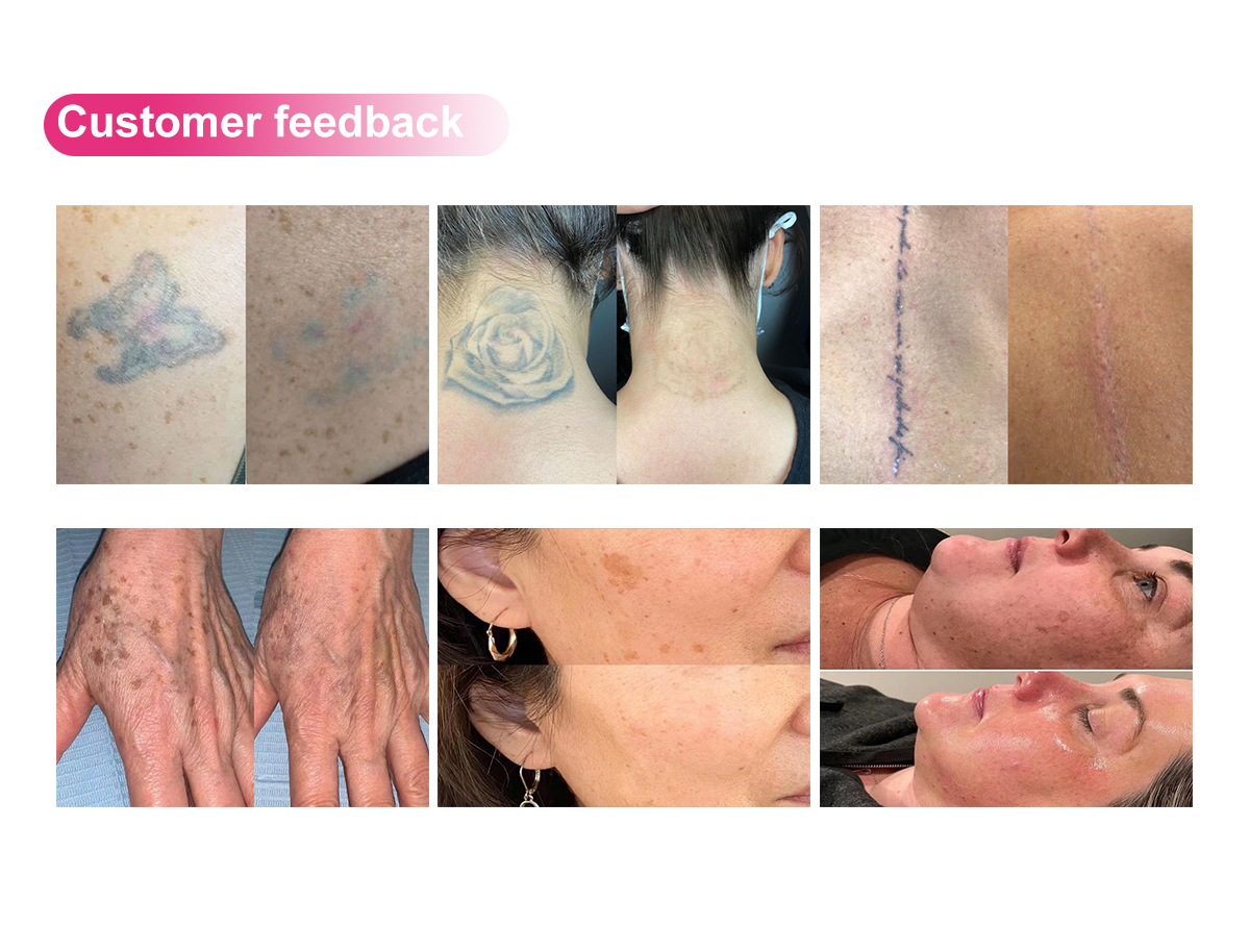 picosecond ND: YAG laser