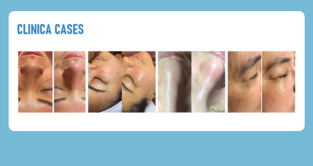 Hydro Facial 9 in 1 Machine Hydro Facial 9 in 1 Machine