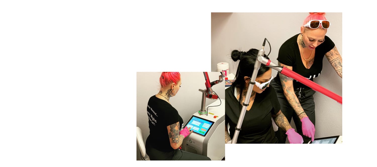 Pico laser, tattoo removal and freckle removal picosound laser